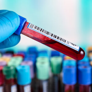 Hand holding tube in hemolyzed blood sample in coagulation. Blood sample for coagulation test in the laboratory